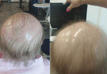 Leczenie łysienia Zielona Góra