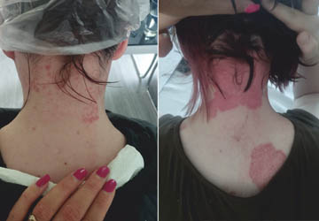 Lecznie skóry gołowy Trycholog Zielona Góra